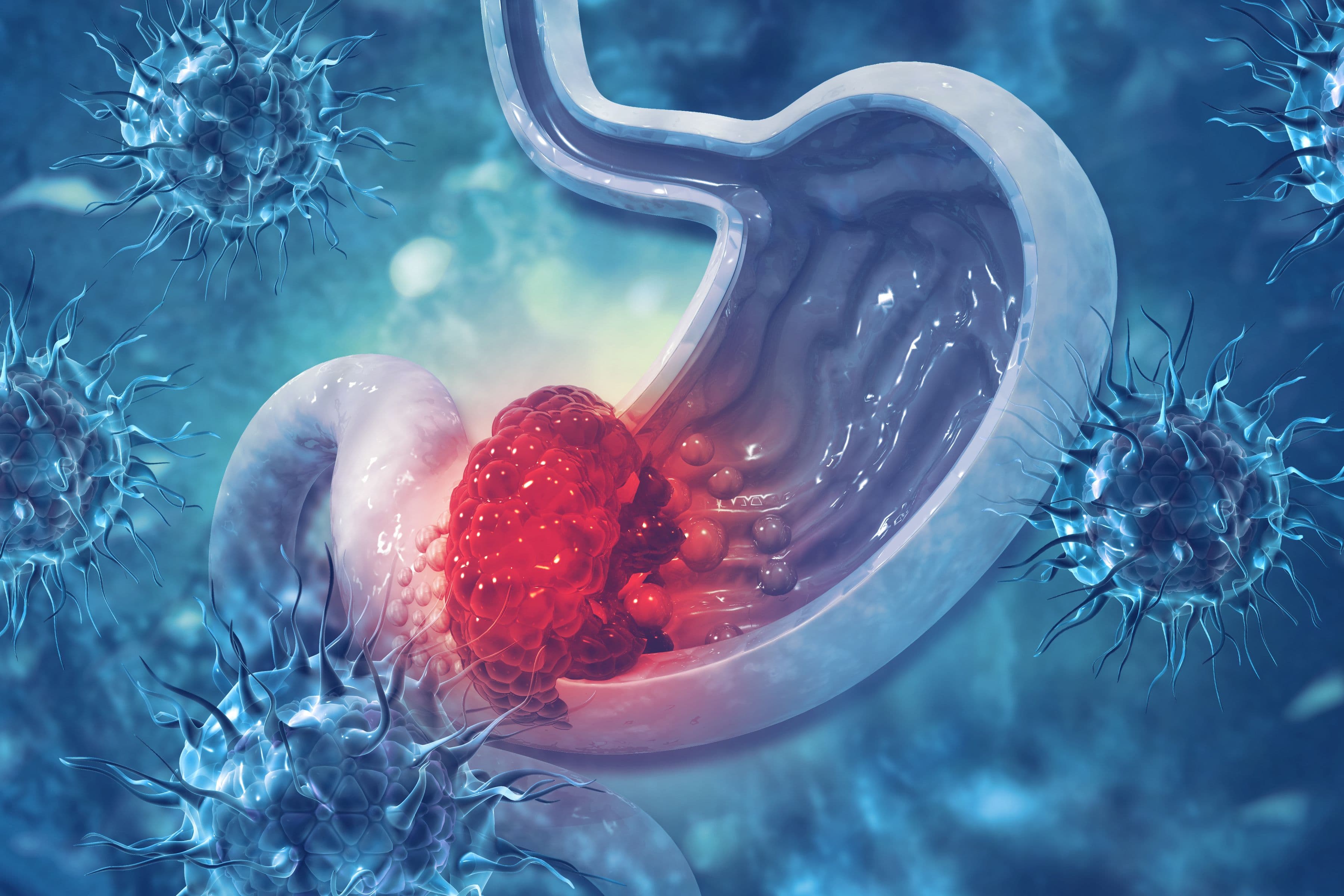 VII Curso Universitario Abordaje Integral del Paciente con Cáncer Esofagogástrico Experto en Consultas de alto riesgo de tumores digestivos_IMAGEN VII Curso Universitario Abordaje Integral del Paciente con Cáncer Esofagogástrico Estudiar en Universidad Privada Madrid
