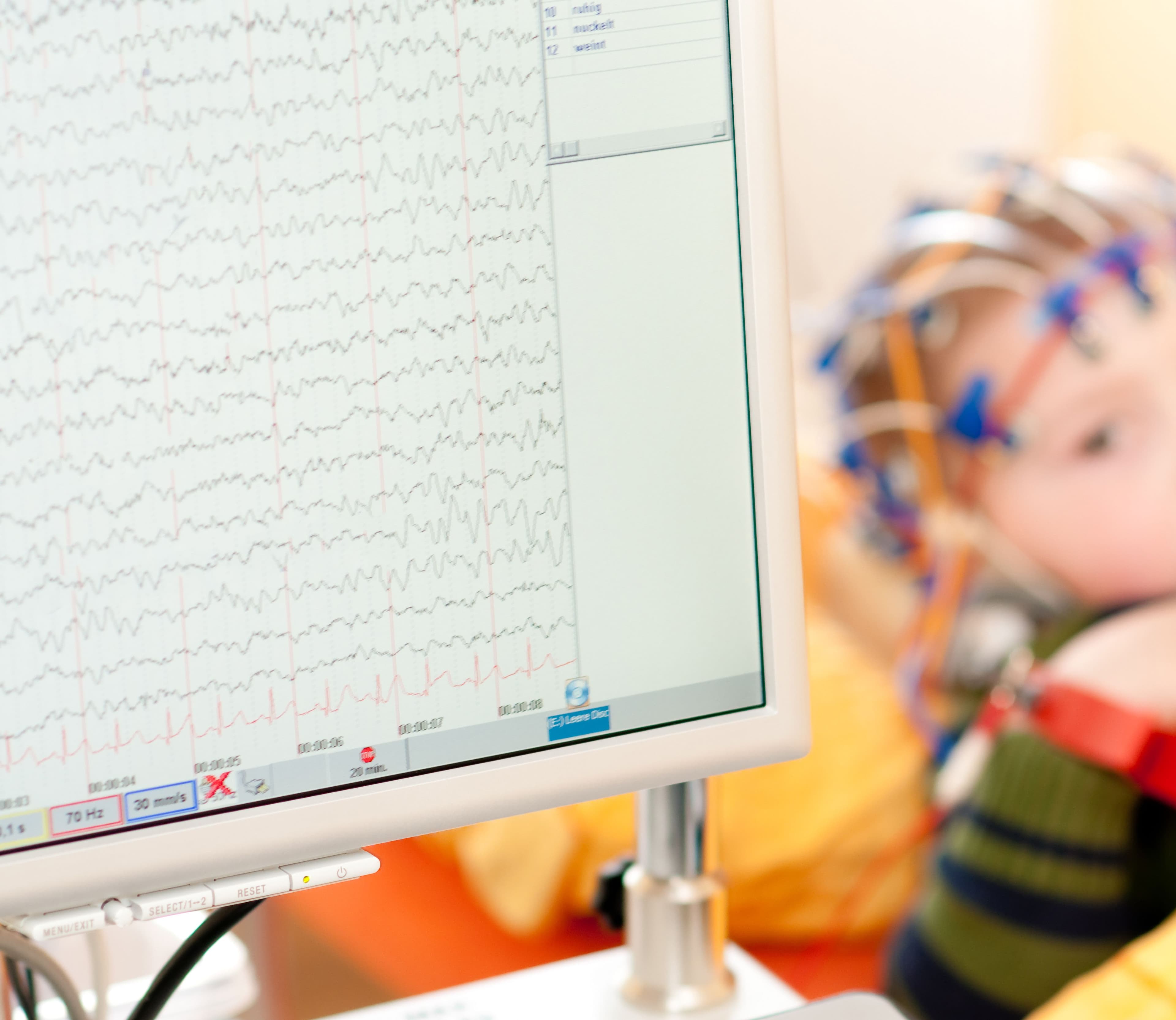 Curso online sobre el manejo y abordaje neuropediátrico, de rehabilitación, psicológico y farmacológico en la Atrofia Muscular Espinal (AME) Master de Formacion Permanente de Epilepsia en Pediatria_IMAGEN Curso online sobre el manejo y abordaje neuropediátrico, de rehabilitación, psicológico y farmacológico en la Atrofia Muscular Espinal (AME) Estudiar en Universidad Privada Madrid