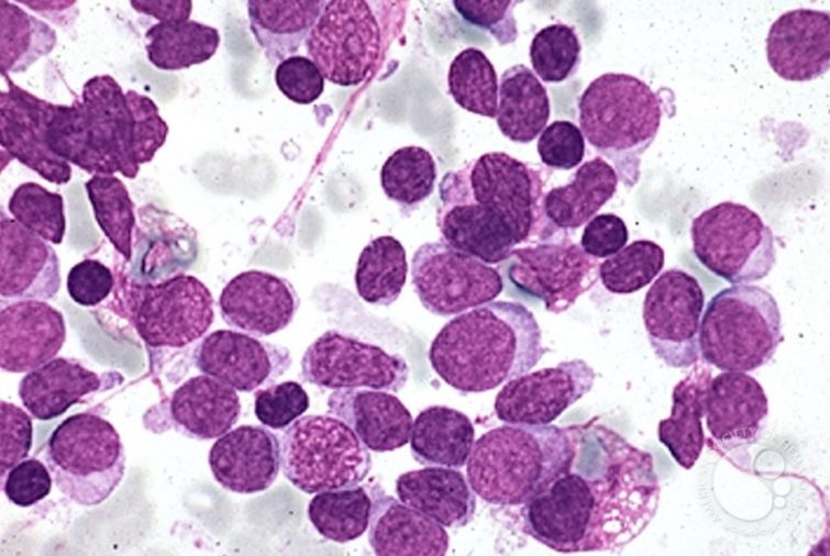 leucemia ufv El Ministerio de Ciencia e Innovación financiará una investigación llevada a cabo por la UFV sobre la leucemia linfoblástica aguda infantil | Noticias de Actualidad UFV Estudiar en Universidad Privada Madrid